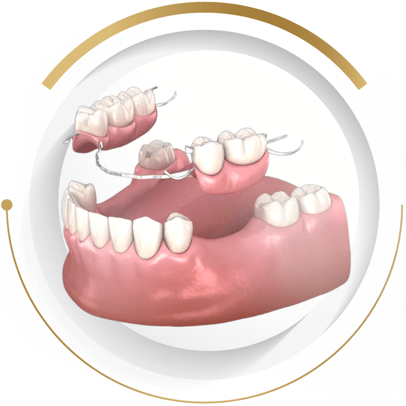 活動假牙